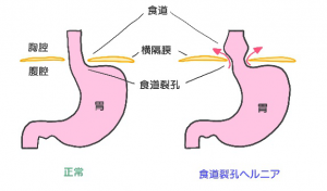 食道裂孔ヘルニア